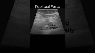 Popliteal Sciatic Nerve Block #emergencymedicine #regionalanesthesia #POCUS #FOAMed #FOAMus