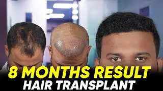 Hair Transplant in Bidar | Best Results & Cost of Hair Transplant in Bidar