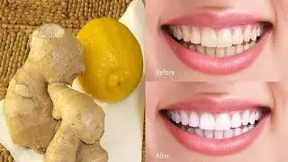 Magical Way to Whiten Your Yellow Teeth at Home in 3 Minutes - Teeth Whitening Instant Remedy