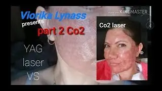 Look what  happened when I did Co2 laser  treatment (fractional laser treatment) part 2