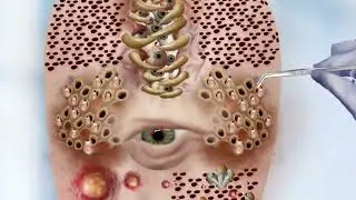 Asmr Scalp Infection Treatment Options｜Therapy Animation | ASMR 2D Animation | @HealAsmr914K