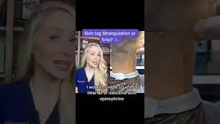 Dermatologist Reacts to Skin Tag Removal 