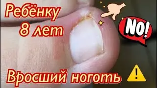 Вросший ноготь😱⚠️❗️ • Ребёнку 8 лет🦶🏻