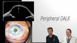 Peripheral DALK to Reinforce Thinned Graft Host Junction in Corneal Graft