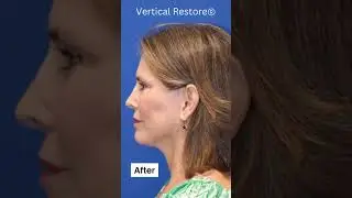 SHOCKING Facelift Transformation! She Looks 20 YEARS YOUNGER!