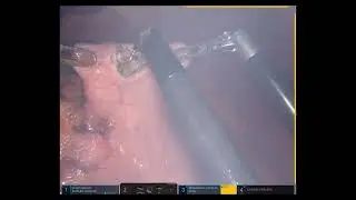 Robotic Excision of Difficult to Access Gastric GISTs