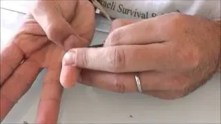 חיתוך עור להוצאת שבב עץ מהאצבע - עזרה ראשונה