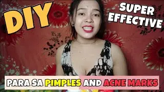 DIY SOLUTION SA PIMPLES AND ACNE MARKS | Rissel Intod