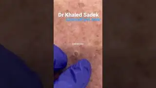 Massive blackhead extraction 
