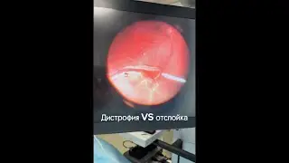 Дистрофия сетчатки/ Отслойка сетчатки. Как не допустить отслойки. О важности лазеркоагуляции.