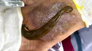 Treatment Documentary: Jalaukavacarana for Skin Diseases