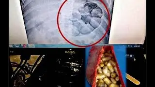 LE ESTALLA CÁPSULA DE COCAÍNA A “MULA” EN CANCÚN