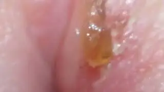Angular Cheilitis.