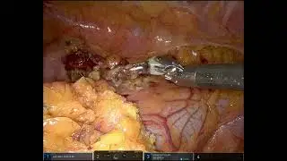 3 port Robotic Resection of Isolated Lung metastasis