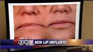 PermaLip Implants