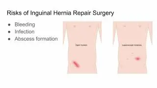 Inguinal Hernia Repair Surgery, Risks and Outcomes - CHI Health