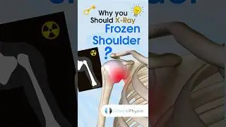 X-Ray Frozen Shoulder? 