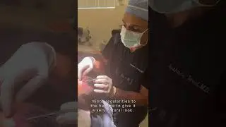Designing the hairline | Anthony Bared MD, FACS | Miami, FL