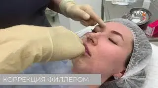 Безоперационная ринопластика