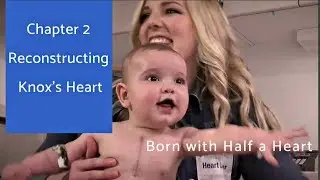 Hypoplastic Left Heart Syndrome | Knox's Stage Two Surgery