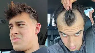 MY ENTIRE BALDING JOURNEY AGE 18 - 23