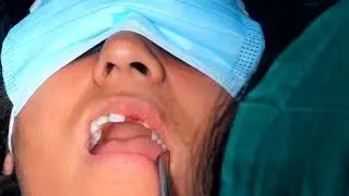 21 - failed Rc treated teeth extraction with replacement of bioline compressive implant