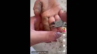 Callous Removal on Kids hands#tiktok #tiktokvideo #satisfying