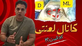 درمان ریشه و پیدا کردن کانالهای دشوار با CBCT | وقتی کانال دندان 