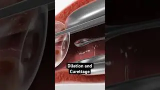 Collecting tissue from the uterus (3D Animation)