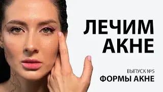 Как возникает акне?
