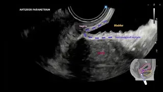 Dynamic transvaginal ultrasound examination for assessing anatomy of parametrium 