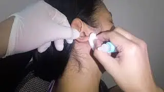 Woman's Impacted Earwax Softened And Removed!