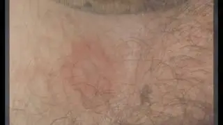 Паховый грибок (грибок в паху)