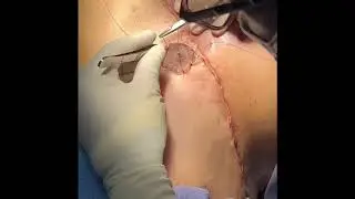 Grade 4 Gynecomastia Surgery Using a Free Graft Approach: Video Footage