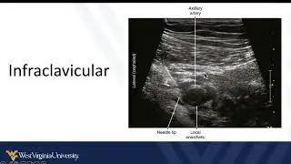 POCUS Guided Regional Anesthesia 2 - Brachial Plexus and Upper Extremity Blocks