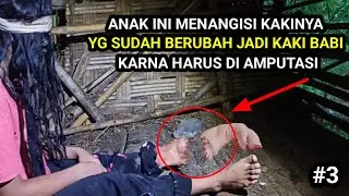🔴 AN4K INI MENANG1SI KAK1NYA YG TELAH BERUB4H JADI KAK1 BAB1 DAN HARUS DI AMPUTAS1 😱😱😱
