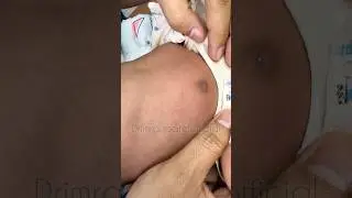 Neonatal GALACTORRHEO #drimranpatel #shorts #shortsfeed