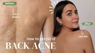 HOW I GOT RID OF BACK ACNE / affordable skincare for bacne