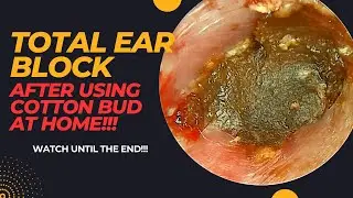 TOTAL Ear Block After Using COTTON BUD At Home!