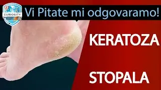 Sveobuhvatan Vodič za Njegu Stopala i Prevenciju Keratoze