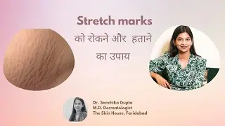 #Stretchmarks - Prevention & Treatment / Dr. Sanchika Gupta 👩‍⚕️ #bestskinspecialistinfaridabad