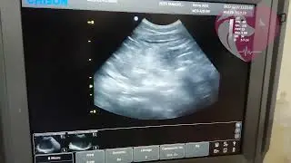 ultrasound (urinary crystals in a blocked tom cat)