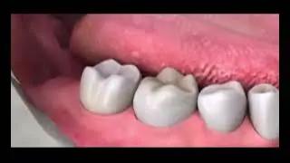 wisdom teeth pain#teeth #wow