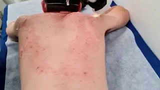 טיפולי אקנה בטכנולוגיית IPL