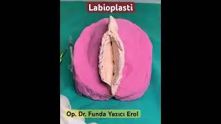 Labioplasti Ameliyatı Nedir? Nasıl Yapılır? #estetik #labioplasti #keşfet #genitalestetik