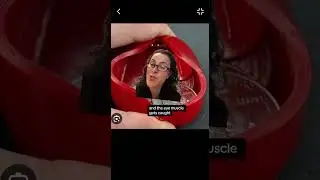 👀🙈 Trapped EYE muscle after minor collision:  White eye orbital fracture explained