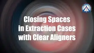 Monday Tip: Closing Spaces in Extraction Cases with Clear Aligners