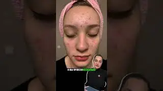 АКНЕ У ПОДРОСТКА 