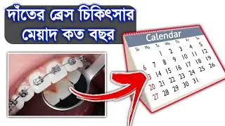 দাঁতের ব্রেস চিকিৎসার মেয়াদ কতদিন Dental braces Timing @Dental Health tips