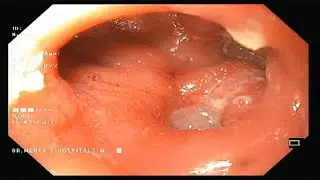Duodenal ulcer| Gastroparesis| Upper gastrointestinal endoscopy| Dr. Pandiaraja
